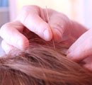 acupuncture-blog3