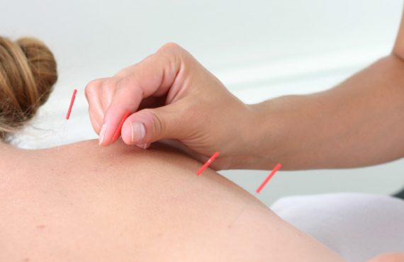 Chinese Moxibustion