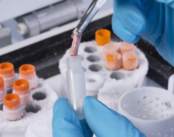 Colorectal Cancer